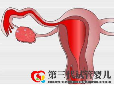 子宮肌瘤做俄羅斯試管嬰兒的成功率高嗎？(圖1)