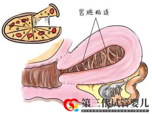 子宮粘連可以做試管嬰兒?jiǎn)幔砍晒β矢卟桓撸?圖1)