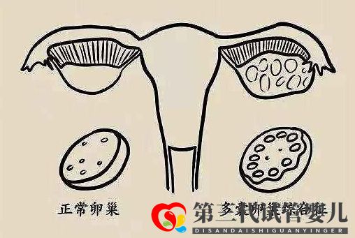 多囊促排懷孕成功率大嗎？(圖1)