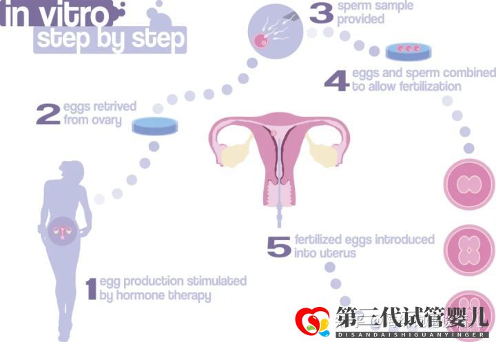 試管嬰兒1代、2代、3代、4代哪個(gè)最好真實(shí)操作過...(圖4)