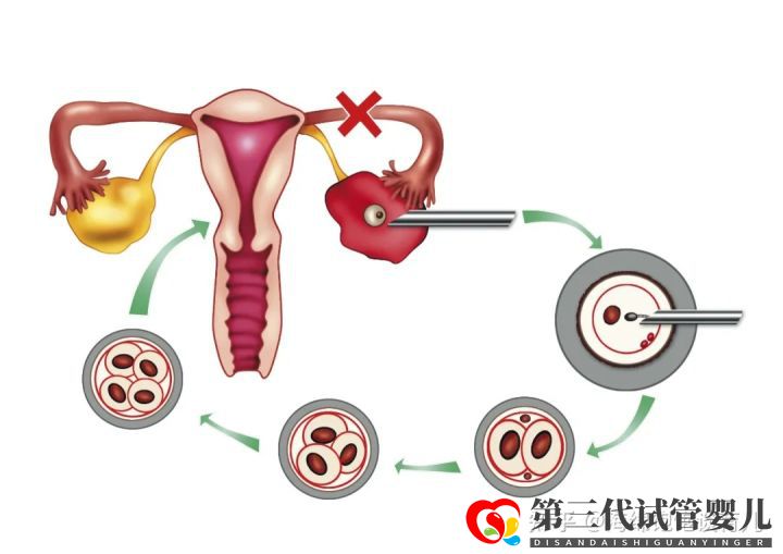 試管嬰兒1代、2代、3代、4代哪個(gè)最好真實(shí)操作過...(圖8)