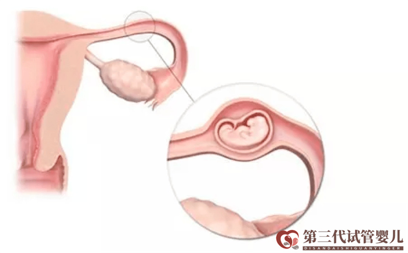 做試管嬰兒是不是可以避免宮外孕了？醫(yī)生告訴你沒(méi)那么簡(jiǎn)單！(圖1)